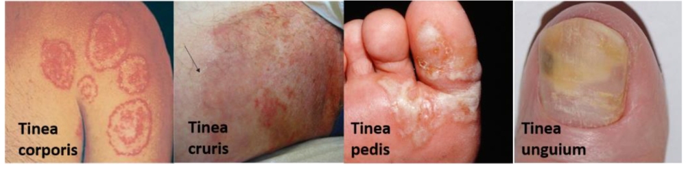 fungal skin infections